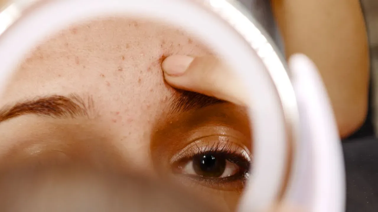 It’s Not a Whitehead, It’s Milia, Here's How to Treat It