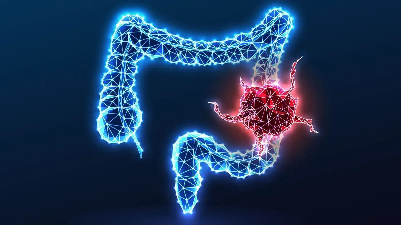 Study reveals new clues to why colorectal cancer in young people is so deadly