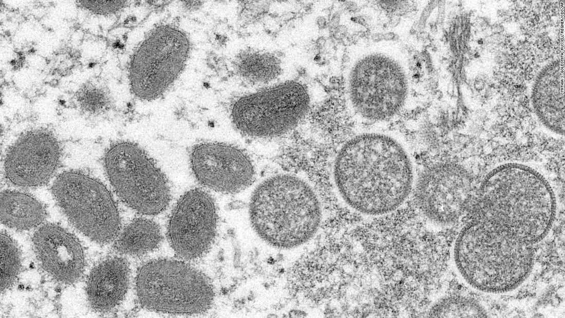 Monkeypox: CDC monitors 6 people in US for possible rare infection, says public 'should not be concerned'