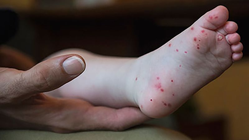 Hand, foot and mouth disease is on the rise in certain areas. What to know