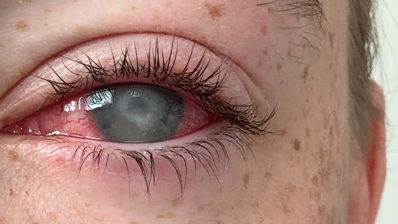 Acanthamoeba keratitis: Symptoms, treatment and how to avoid this parasitic eye disease