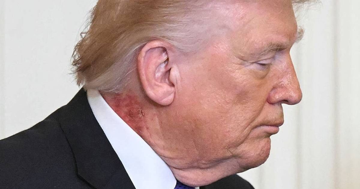 CNN delivers new Donald Trump health update as doctor speaks out on neck rash condition