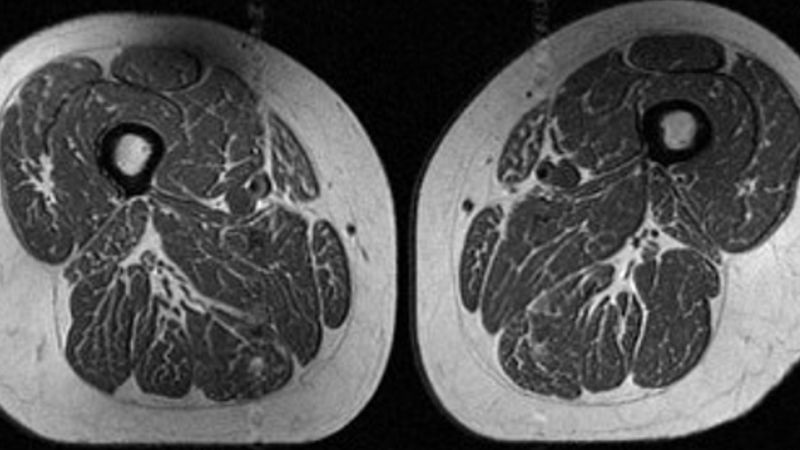 Overeating ultraprocessed foods linked to fatty muscles and knee osteoarthritis, study says