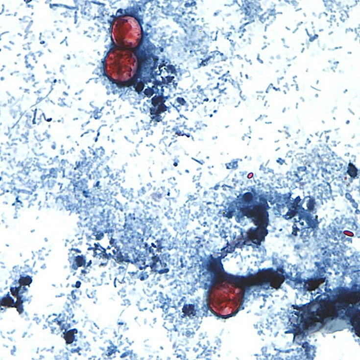 Melanie Moser/CDC/AP via CNN NewsourceAn outbreak of illnesses from the cyclospora parasite has now been connected in nine states.